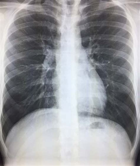 Calcified Granuloma On Chest X Ray Radiology In Plain English
