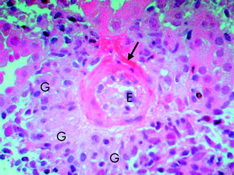 Pathology Outlines Henoch Schonlein Purpura