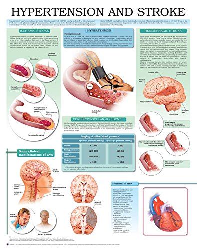 Hypertension And Stroke E Chart Full Illustrated Ebook