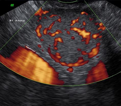 Ovarian Cysts Womens Ultrasound Clinicwomens Ultrasound Clinic