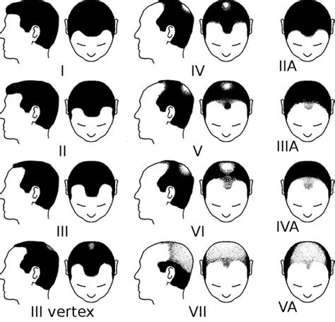 How Fast Does Male Pattern Baldness Progress Quora