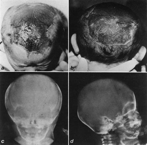 Nonsurgical Approach To Congenital Scalp And Skull Defects In Journal