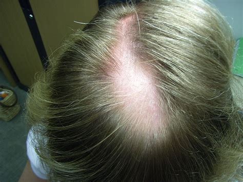 The Hair Loss Centre Alopecia Areata Results