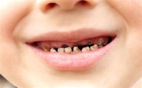 It doesnt matter if it already got rotten holes in it, brush. Tooth decay could be lasered away with five-minute blast ...