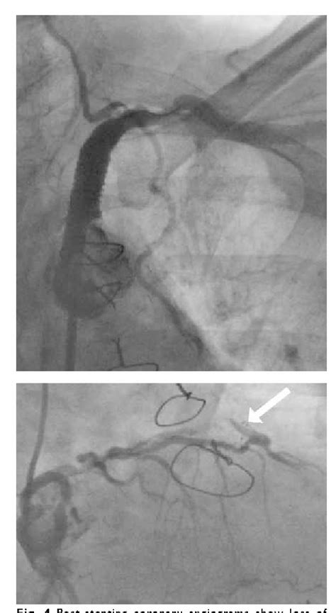 Figure 4 From Coronary Subclavian Steal Syndrome A Rare Cause Of Acute
