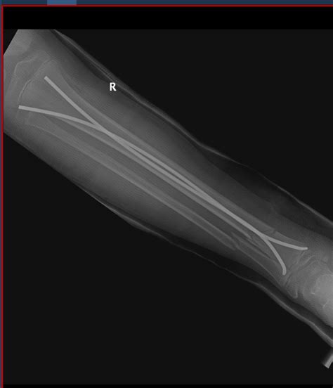 Case Open Tibial Shaft Fracture In An 11 Years Male