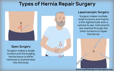 Learn About Six Types Of Hernia Southlake General Surgery
