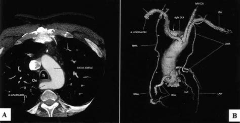 Pdf Arteria Lusoria Developmental Anatomy Clinical Radiological My