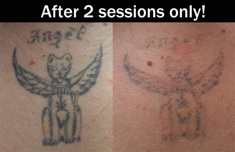 Laser Tattoo Removal Eternal Art