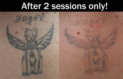 During a laser tattoo removal treatment, the laser's high energy light breaks up the tattoo ink into tiny particles, which are gradually absorbed by the skin. Laser Tattoo Removal « Eternal-Art