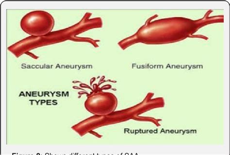 Figure 2 From Spontaneous Rupture Of Splenic Artery Aneurysm Reported