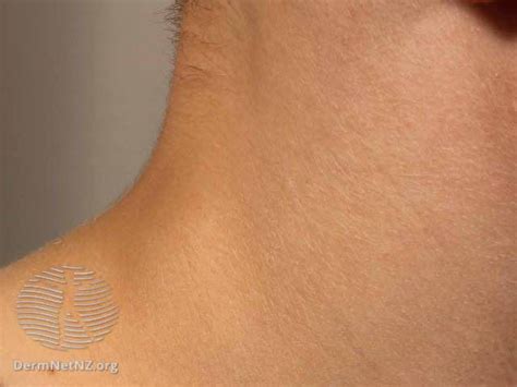 How To Tell A Lump From A Lymph Node