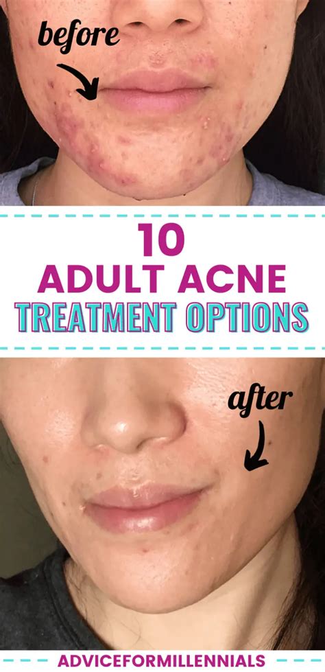 10 Adult Acne Treatment Options You Probably Haven T Tried Yet Advice For Millennials
