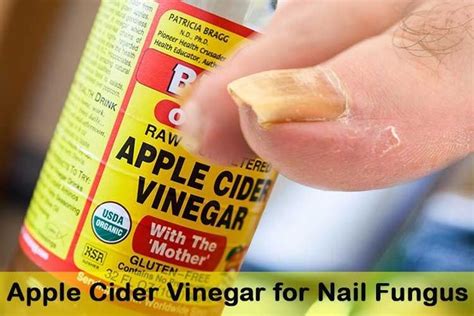 How To Use Apple Cider Vinegar For Nail Fungus Apple Cider Vinegar