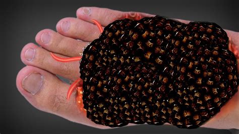 How To Remove Trypophobia Worms Infected Toe Asmr Severely Deep