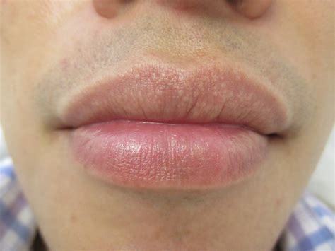 Small White Dots In Lips After Filler