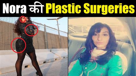 Surgery Nora Fatehi Bollywood Actress Plastic