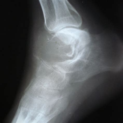 Lateral Radiograph Of Ankle Showing A Radiolucent Lesion Occupying The