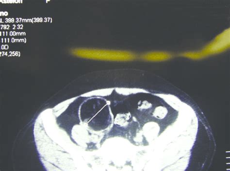 Pelvic CT Scan Showing The Right Ovarian Cyst Marked On The Left Side