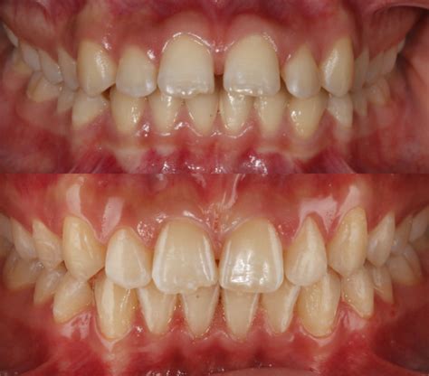 Ortodoncia Invisible Para Corregir Sonrisa Gingival Clínica Peydro
