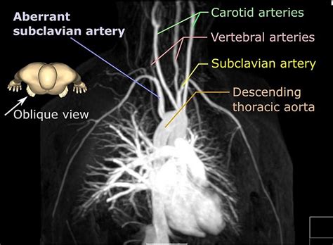 Subclavian Artery Diagram