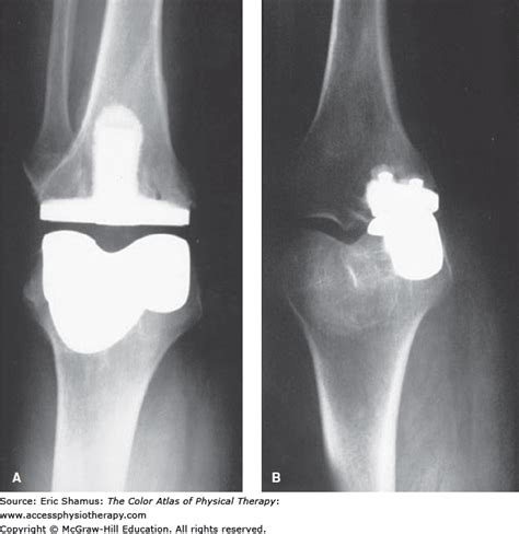 Bilateral Osteoarthritis Knee Icd 10 2023