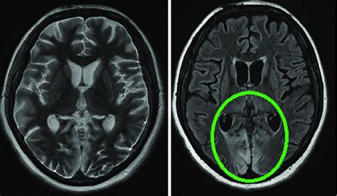 Patients Mri Head Scan 30 Days After Hospital Admission T2wi On The