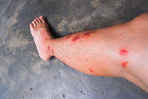 Insect Bite Of Man Leg Stock Photo Image Of Human Medical 229493876