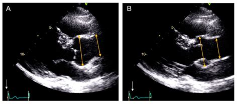 Jcm Free Full Text Are Aortic Root And Ascending Aorta Diameters