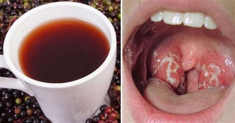 10 Natural Remedies To Fight Strep Throat