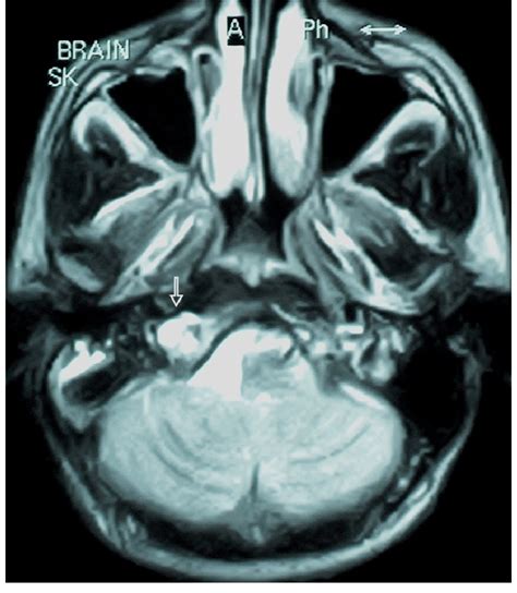 T2 Weighted Axial Mri Showing A Large Hyperintense Lesion With No