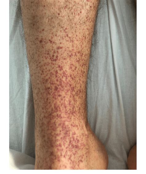 Petechiae On The Patients Right Leg In The Emergency Room Download