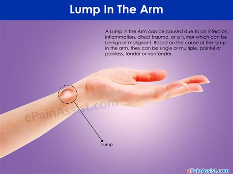 What Can Cause A Lump In The Arm And How Is It Treated Or Removed