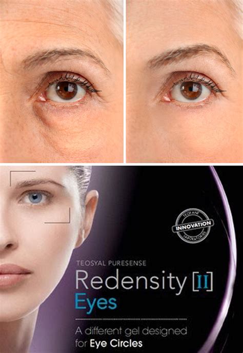 Teosyal Redensity Ii For A Refreshed Look The London Facial Care