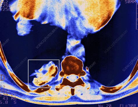 Asbestosis Ct Scan Stock Image M1080606 Science Photo Library