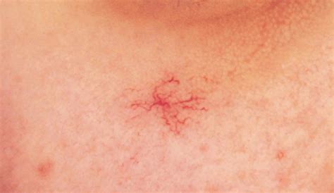 Spider Nevus Treatment Adelaide Acm Laser Clinic