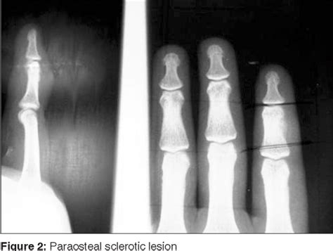 Fibro Osseous Pseudotumor Of The Digit Semantic Scholar