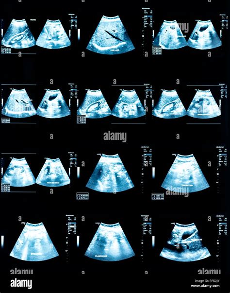 Echography Image Ultrasound Of Abdomen Stock Photo Alamy