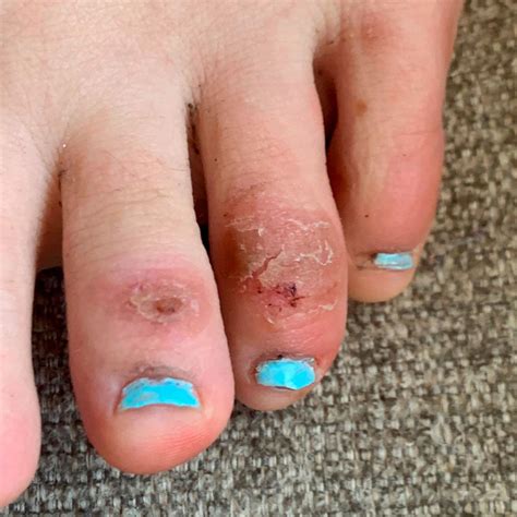Covid Toes Other Rashes Latest Possible Rare Virus Signs