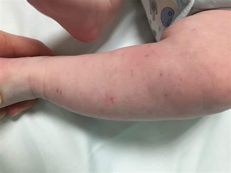 Meningitis Pin Prick Rash On Leg Raising The Rings