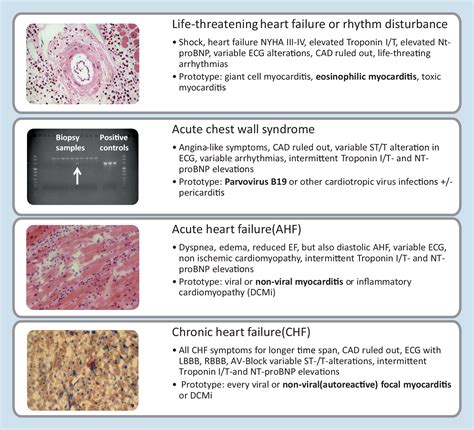 Esc guidelines for the diagnosis and treatment of acute and chronic heart failure 2012/ the task force for the diagnosis and. Treatment options in myocarditis and inflammatory ...
