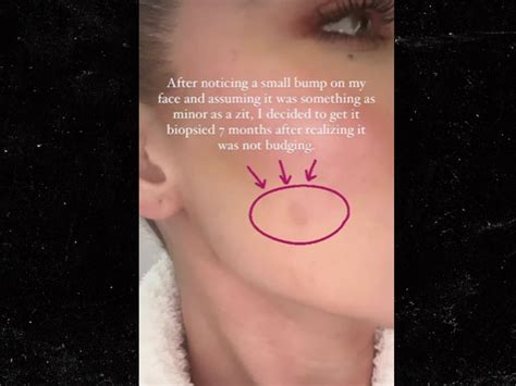 Khloe Kardashian Reveals Skin Cancer Scare Tumor Removed From Face