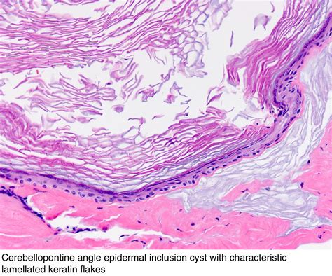 Pathology Outlines Epidermal Epidermoid Type