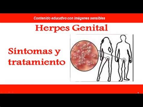 Herpes Genital S Ntomas Y Tratamiento Del Herpes Genital Youtube