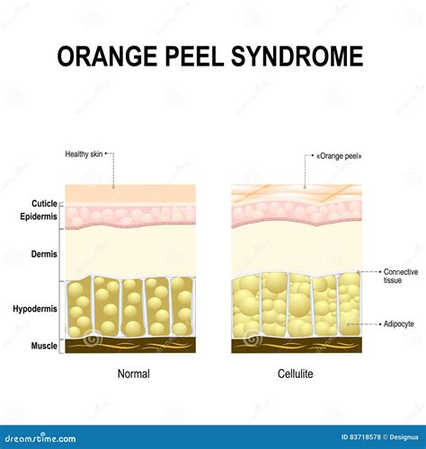 Cellulite Or Orange Peel Syndrome Vector Illustration Cartoondealer