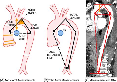 Aortic Arch Tortuosity A Novel Biomarker For Thoracic Aortic Disease