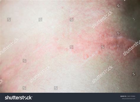 Urticaria On Skin Rashes Which Urticaria Stock Photo 1565150482