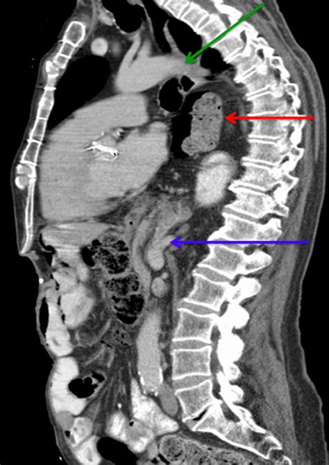 Thoracic Spine Ct Scan