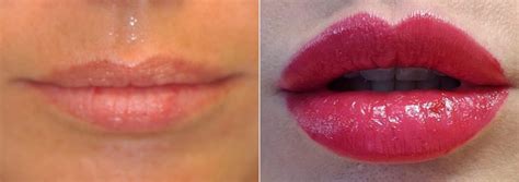 Lip Augmentation Photos Chevy Chase Md Patient 14788