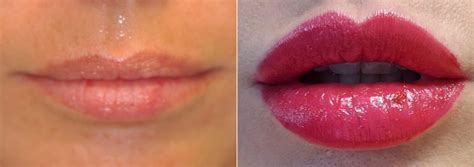 Lip Augmentation Best Lip Injections Virginia Washington Dc Maryland